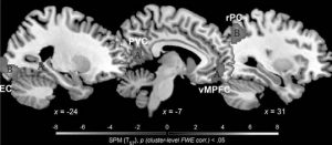Figura 3.1 - aree cerebrali coinvolte nella processazione di immagini pittoriche (A) e fotografiche (B) (EC corteccia extrastriata; pvc corteccia visiva primaria; rpc corteccia parietale destra; vMpfc corteccia prefrontale ventromediale) (Lutz 2013). 